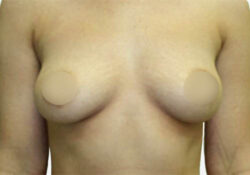 Breast Augmentation