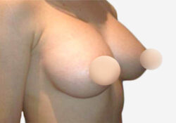 Breast Augmentation