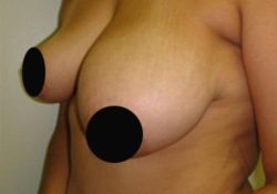 Breast Asymmetry Correction