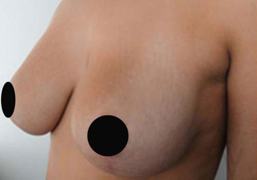 Breast Asymmetry Correction