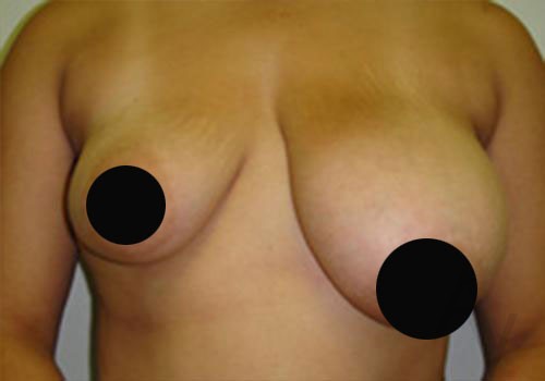 Breast Asymmetry Before and after photos by Toronto plastic surgeon Dr. Golger