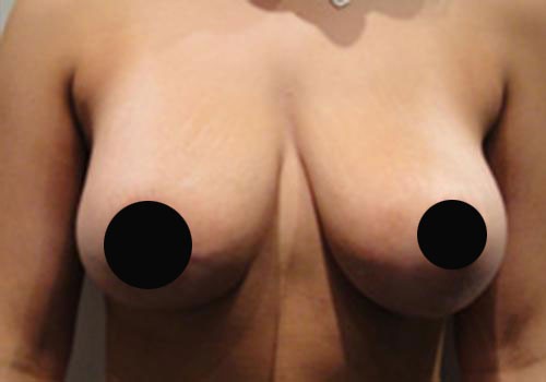 Breast Asymmetry Before and after photos by Toronto plastic surgeon Dr. Golger