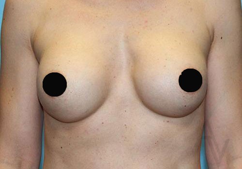 Breast Augmentation Case 493 After Photo Breast Augmentation