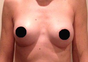 Breast Augmentation