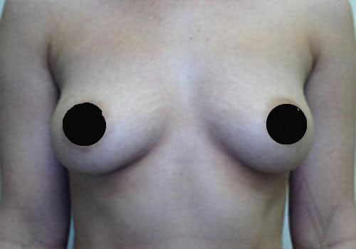 Breast Augmentation Case 494 Before Photo Breast Augmentation