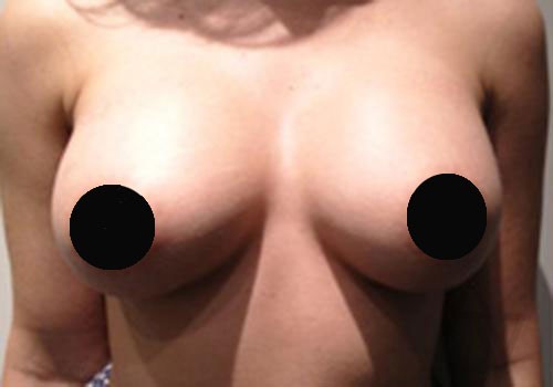 Breast Augmentation Case 494 After Photo Breast Augmentation