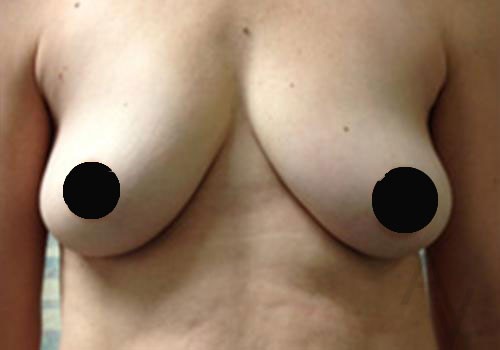 Breast Augmentation