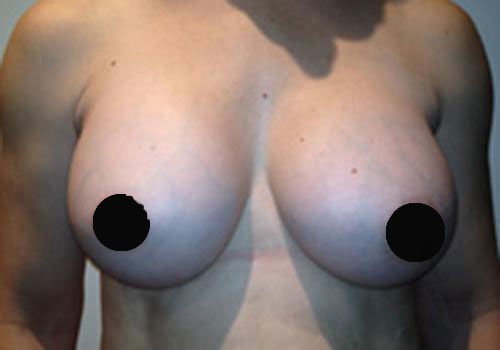 Breast Augmentation