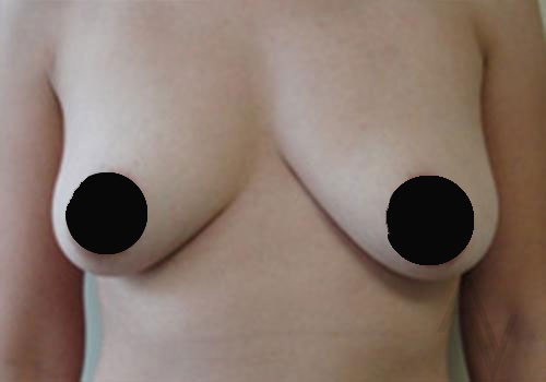 Breast Augmentation