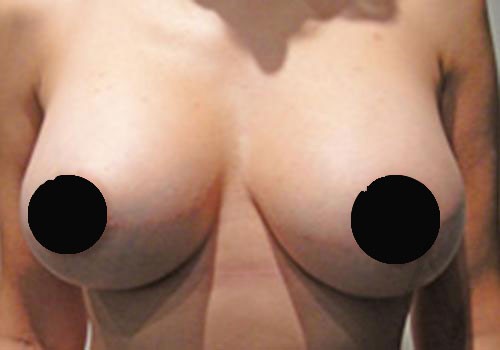 Breast Augmentation