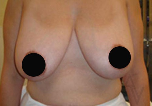 Breast Reduction Case 516 Before Photo Breast Reduction