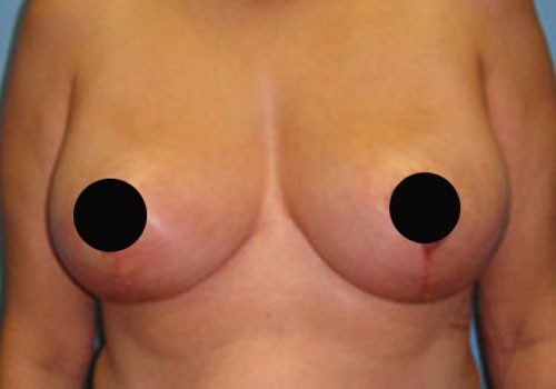 Breast Reduction Case 516 After Photo Breast Reduction