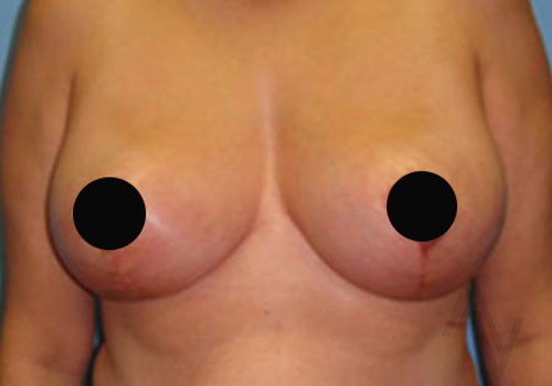 Breast Reduction