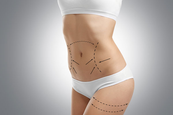 liposuction