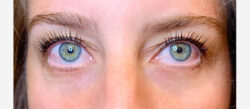 Eyelid Surgery