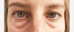 Eyelid Surgery