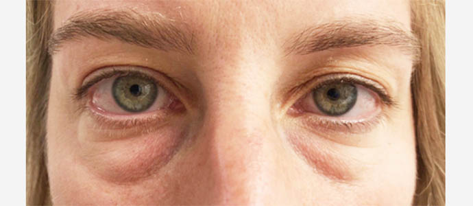 Eyelid Surgery