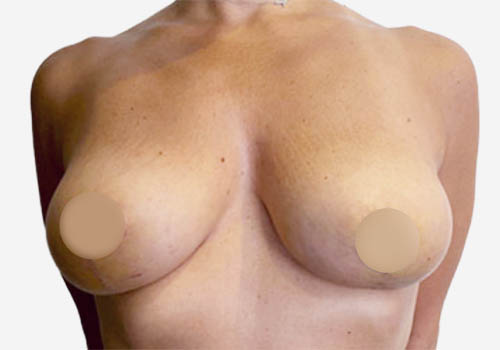 Breast Lift