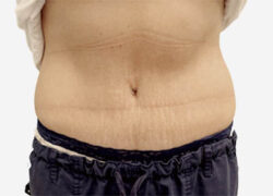 Tummy Tuck