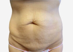 Tummy Tuck