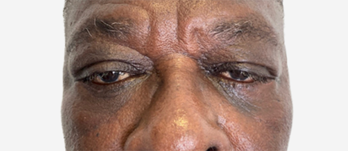 Eyelid Surgery