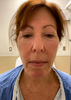 Face & Neck Lift