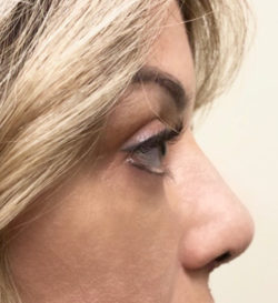 Rhinoplasty