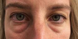 Eyelid Surgery