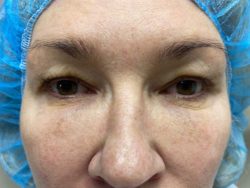 Eyelid Surgery