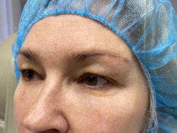 Eyelid Surgery