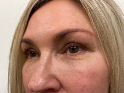 Eyelid Surgery