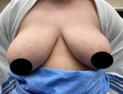 Breast Reduction