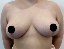 Breast Reduction