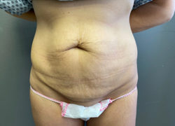 Tummy Tuck