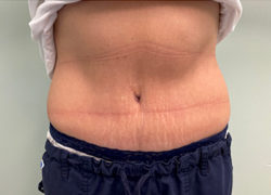 Tummy Tuck