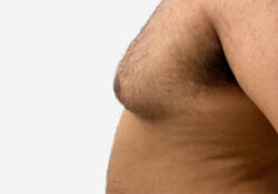 Male Breast Reduction