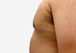 Male Breast Reduction