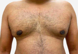 Male Breast Reduction