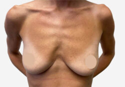 Breast Augmentation