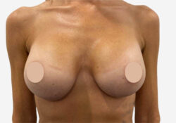 Breast Augmentation