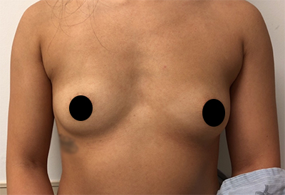 Breast Augmentation