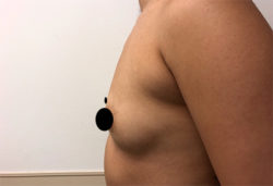 Breast Augmentation