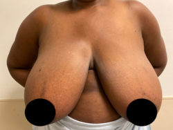 Breast Reduction