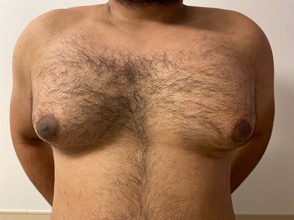 Male Breast Reduction