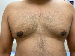 Male Breast Reduction