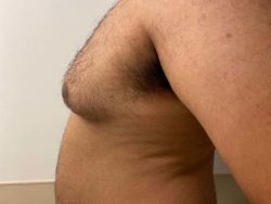 Male Breast Reduction