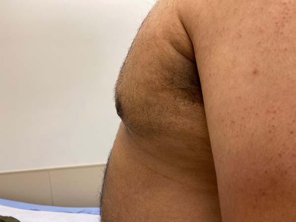 Male Breast Reduction