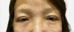 Eyelid Surgery