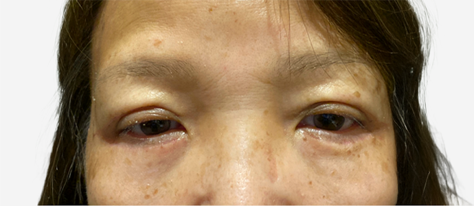 Eyelid Surgery