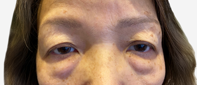 Eyelid Surgery
